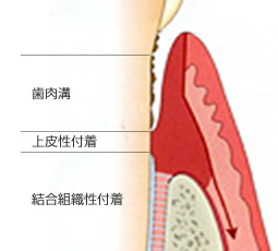 歯周形成の治療